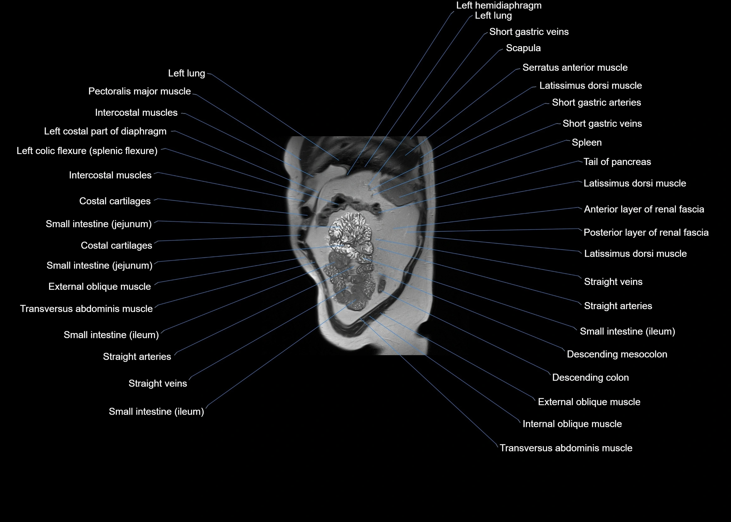 MRI abdomen sagittal cross sectional anatomy  radiology  image-img-00001-00059.webp